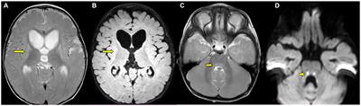 Methylmalonic aciduria as a biochemical marker for mitochondrial DNA depletion syndrome in patients with developmental delay and movement disorders: a case series